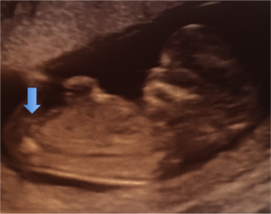 イギリス ロンドンで妊娠生活 イギリスの初エコー検査 出生前診断 12週 Live A Little