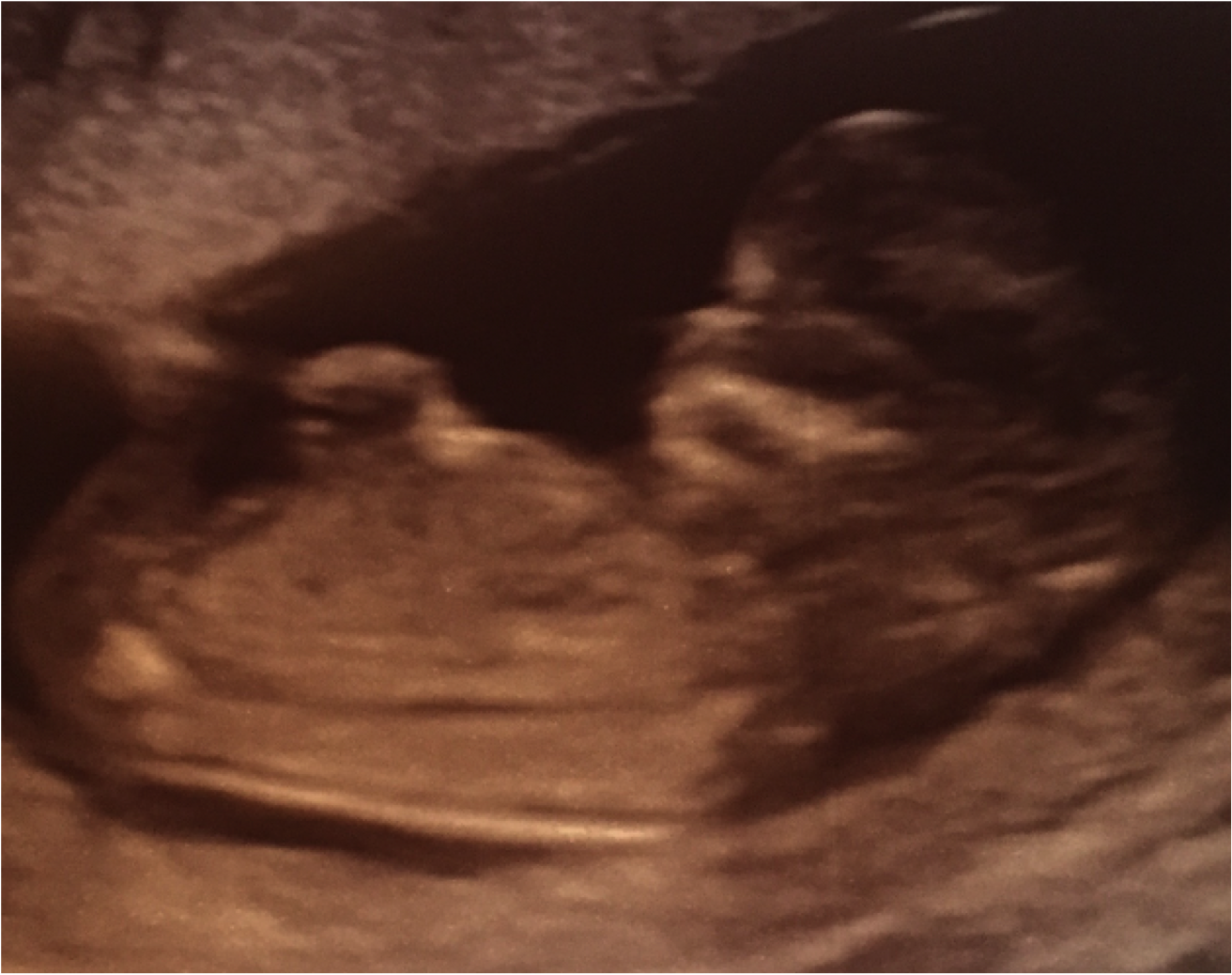 イギリス ロンドンで妊娠生活 イギリスの初エコー検査 出生前診断 12週 Live A Little